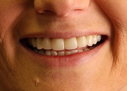 Closeup of perfectly repaired smile