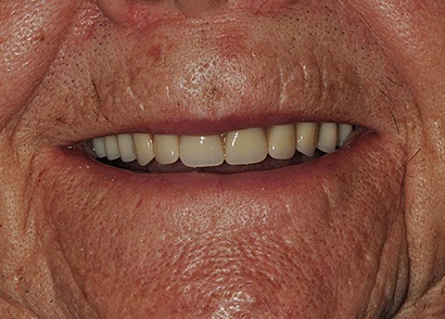 Closeup of repaired and replaced teeth