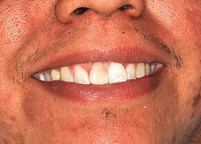Closeup of discolored smile