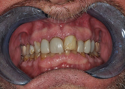 Damaged and cracked front tooth