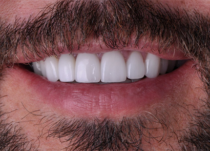 Aligned and healthy smile