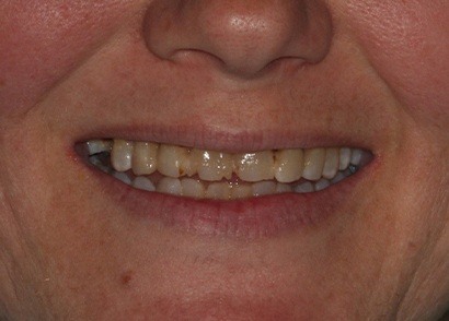 Closeup of damaged decayed teeth