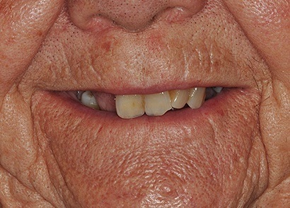 Closeup of smile wiht missing and damaged teeth