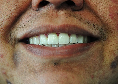 Closeup of brilliant white smile