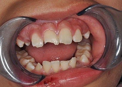 Cracked front teeth