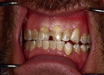 Uneven and decyaed teeth