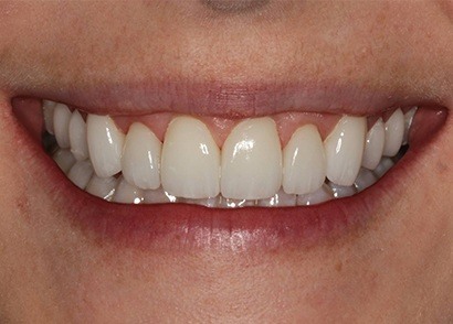 Aligned and healthy smile