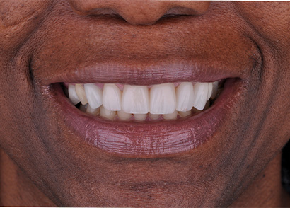 Aligned and healthy smile