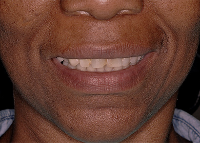 Uneven and decyaed teeth