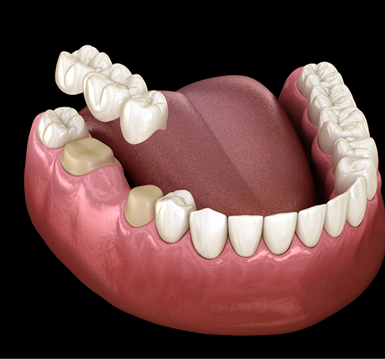 Illustration of dental bridge in Midlothian being attached to lower arch of teeth