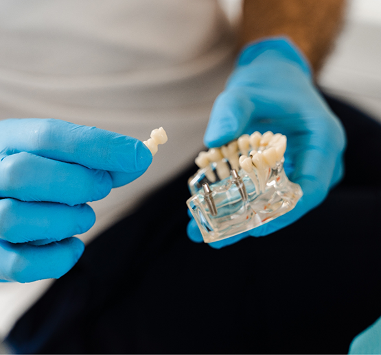 Gloved hands holding dental bridge and model of dental implant