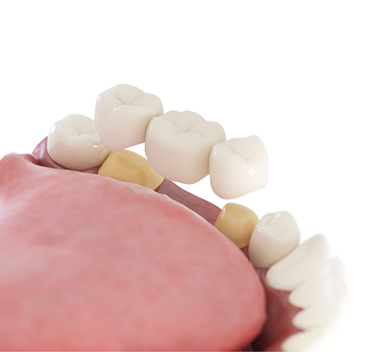 Illustration of bottom of mouth with traditional dental bridge being attached