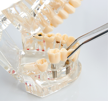 Using forceps to attach dental bridge to dental implants in plastic model