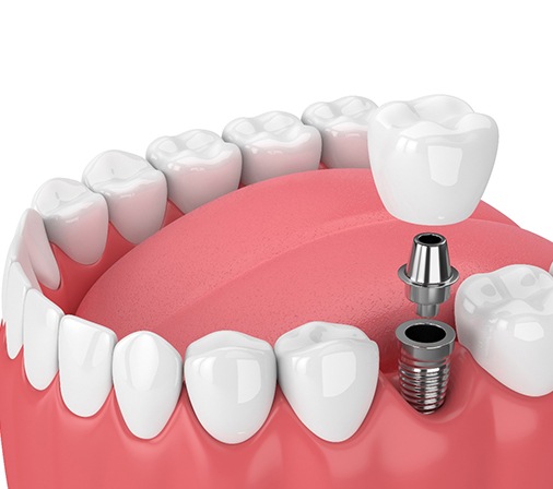 dental implant being placed in the lower jaw