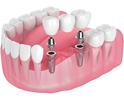 dental bridge being placed onto two dental implants