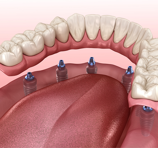 Illustration of implant dentures in Midlothian being attached
