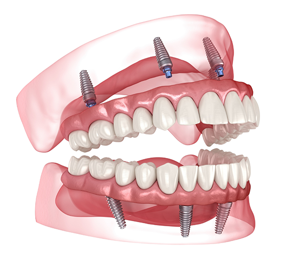 Illustration of implant dentures in upper and lower arch