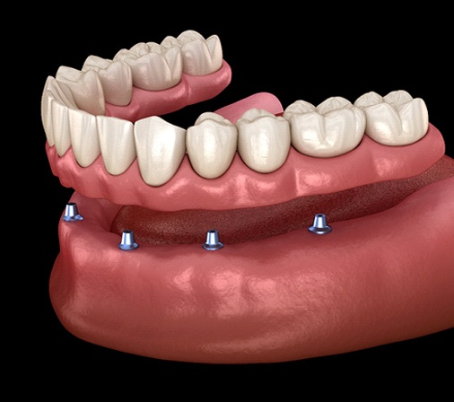 Implant dentures