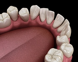 Illustration of gapped teeth
