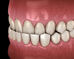 Illustration of underbite