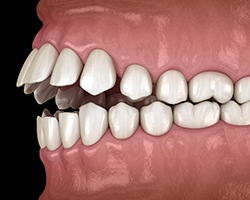 Illustration of openbite