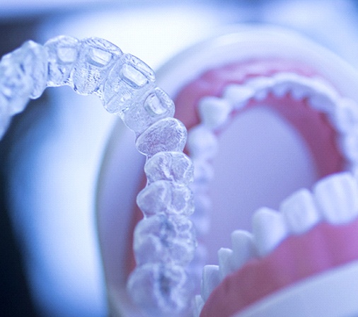 Invisalign aligners being placed on a model of a mouth