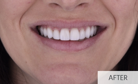smile after dental implant