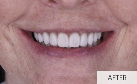 patient after gummy smile correction