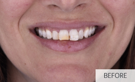 smile before dental implant