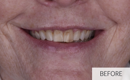 patient before gummy smile correction