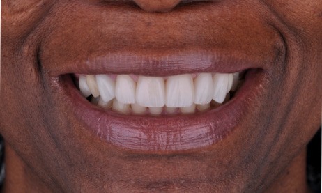 smile after porcelain veneers