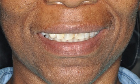smile before porcelain veneers
