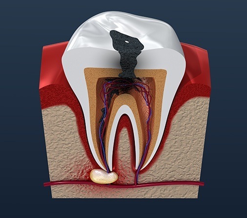 Animation of damaged tooth