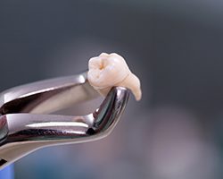 A dentist preparing to extract a patient’s tooth