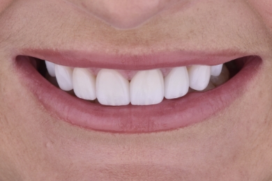 Smile after treatment