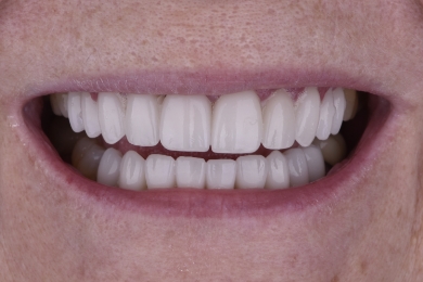 Smile after treatment