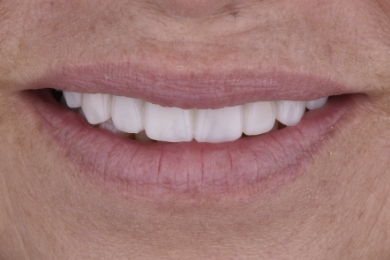 Smile after treatment