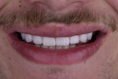 Smile after treatment