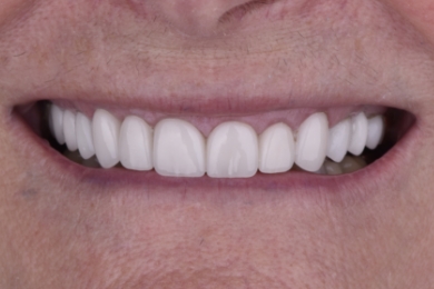 Smile after treatment