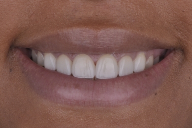 Smile after treatment