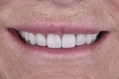 Smile after treatment