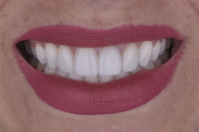 Smile after treatment