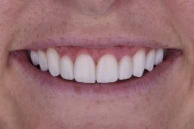 Smile after treatment
