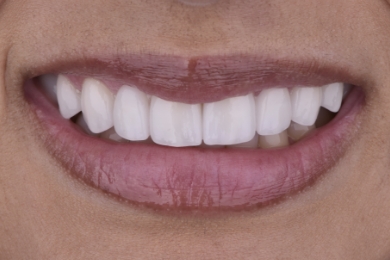 Smile after treatment