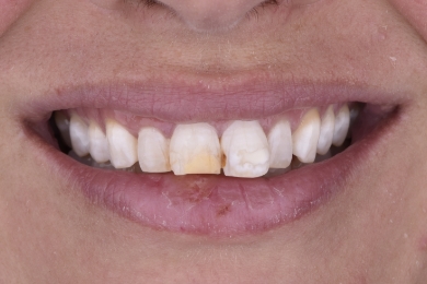 Smile before treatment