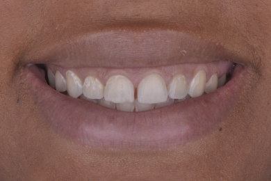 Smile before treatment