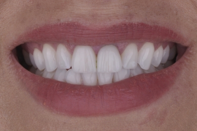 Smile before treatment