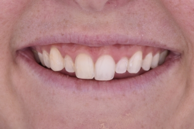 Smile before treatment