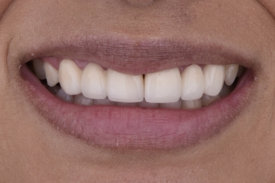 Smile before treatment