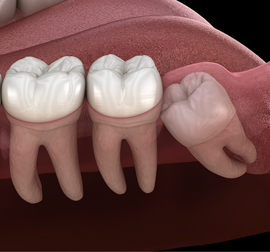 Illustration of tooth impacted under gums